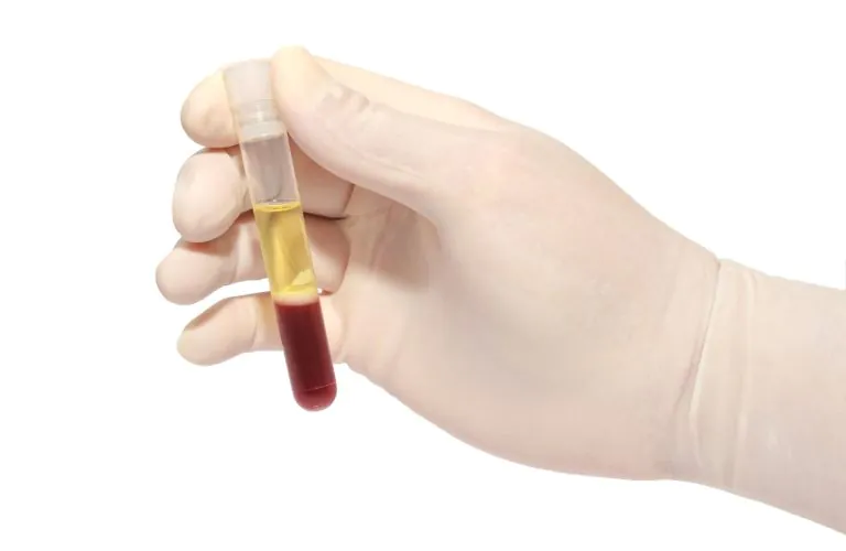 plasma rico em plaquetas – prp (grande)